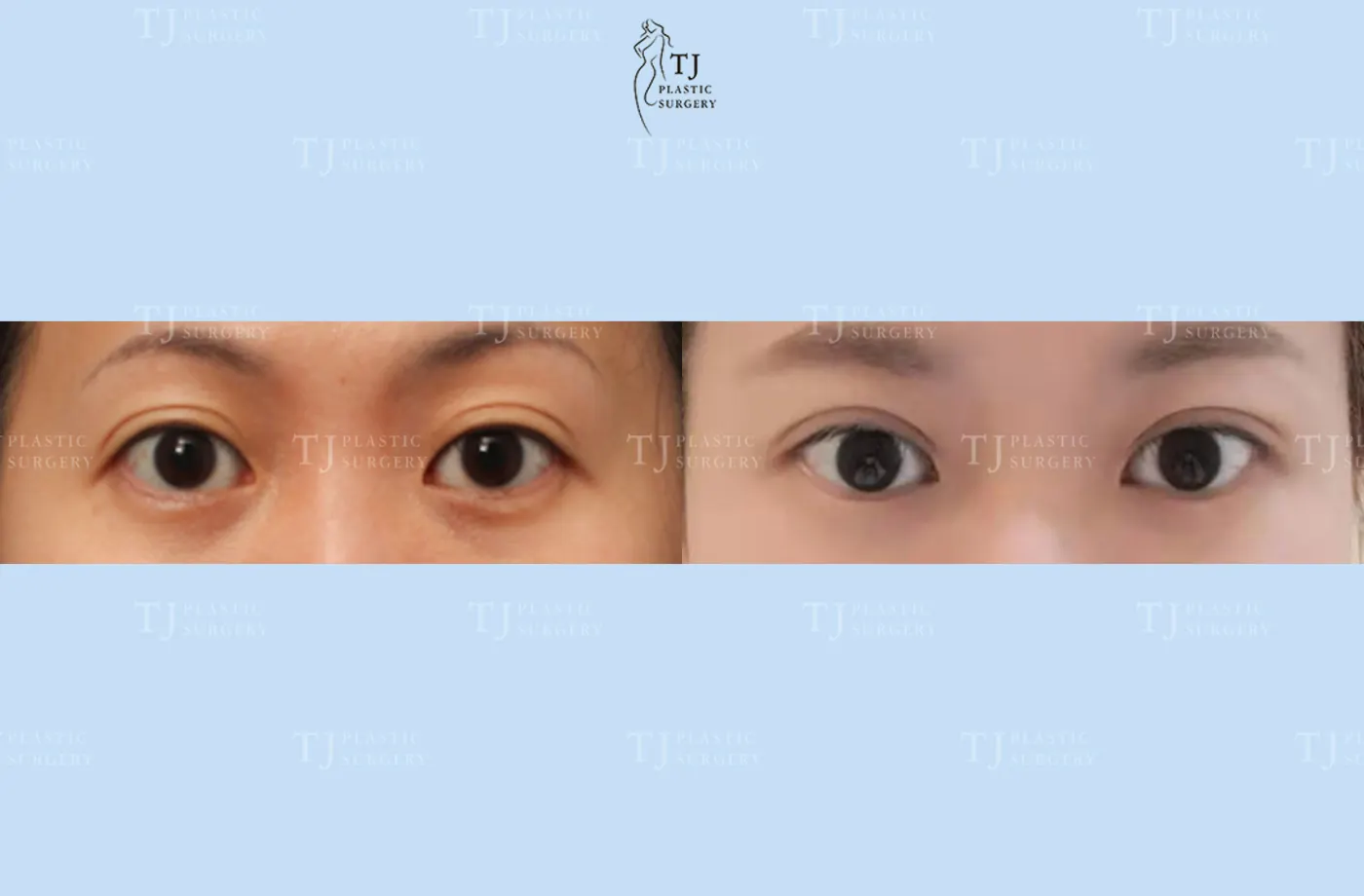 Eyelid surgery at TJ Plastic Surgery Clinic — Front view; before on the left · after on the right