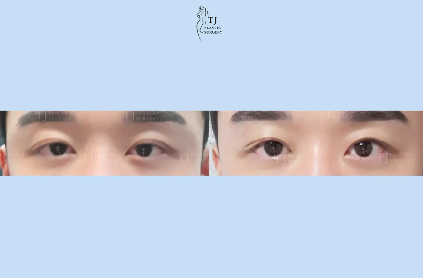 Eyelid surgery at TJ Plastic Surgery Clinic — Front view; before on the left · after on the right