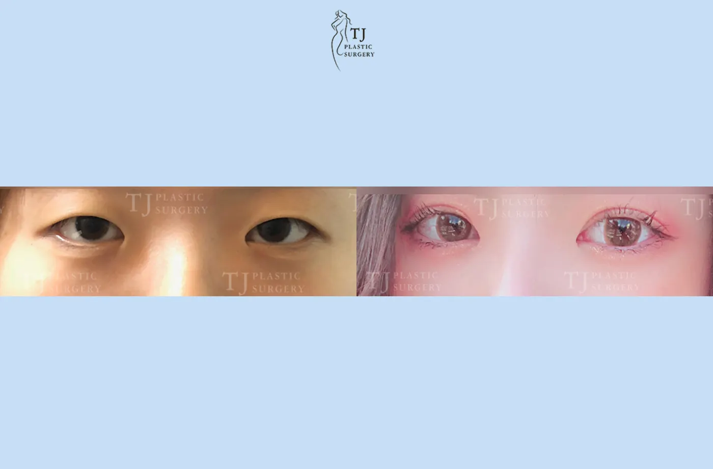 Eyelid surgery at TJ Plastic Surgery Clinic — Front view; before on the left · after on the right