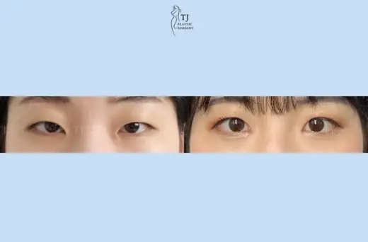 Eyelid surgery — front view before and after at TJ Plastic Surgery Clinic