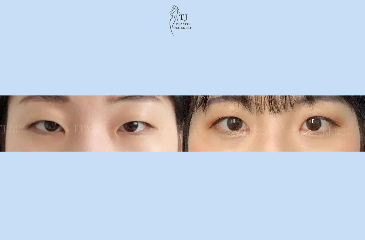 Eyelid surgery at TJ Plastic Surgery Clinic — Front view; before on the left · after on the right