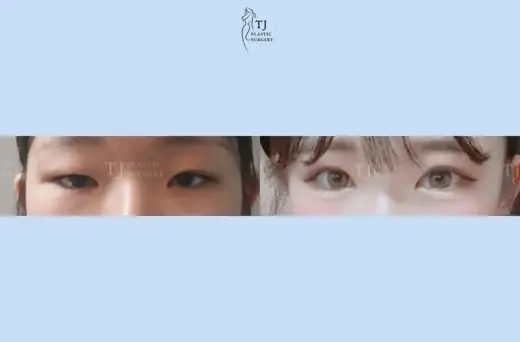 Eyelid surgery — front view before and after at TJ Plastic Surgery Clinic