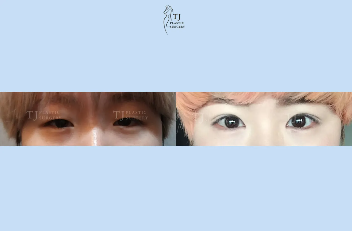Eyelid surgery at TJ Plastic Surgery Clinic — Front view; before on the left · after on the right