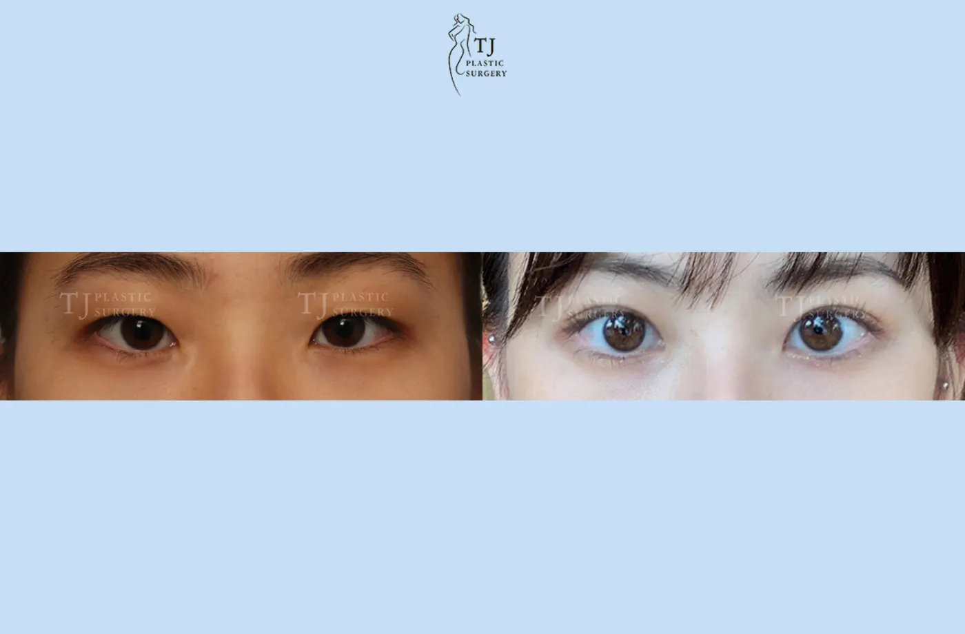 Eyelid surgery at TJ Plastic Surgery Clinic — Front view; before on the left · after on the right