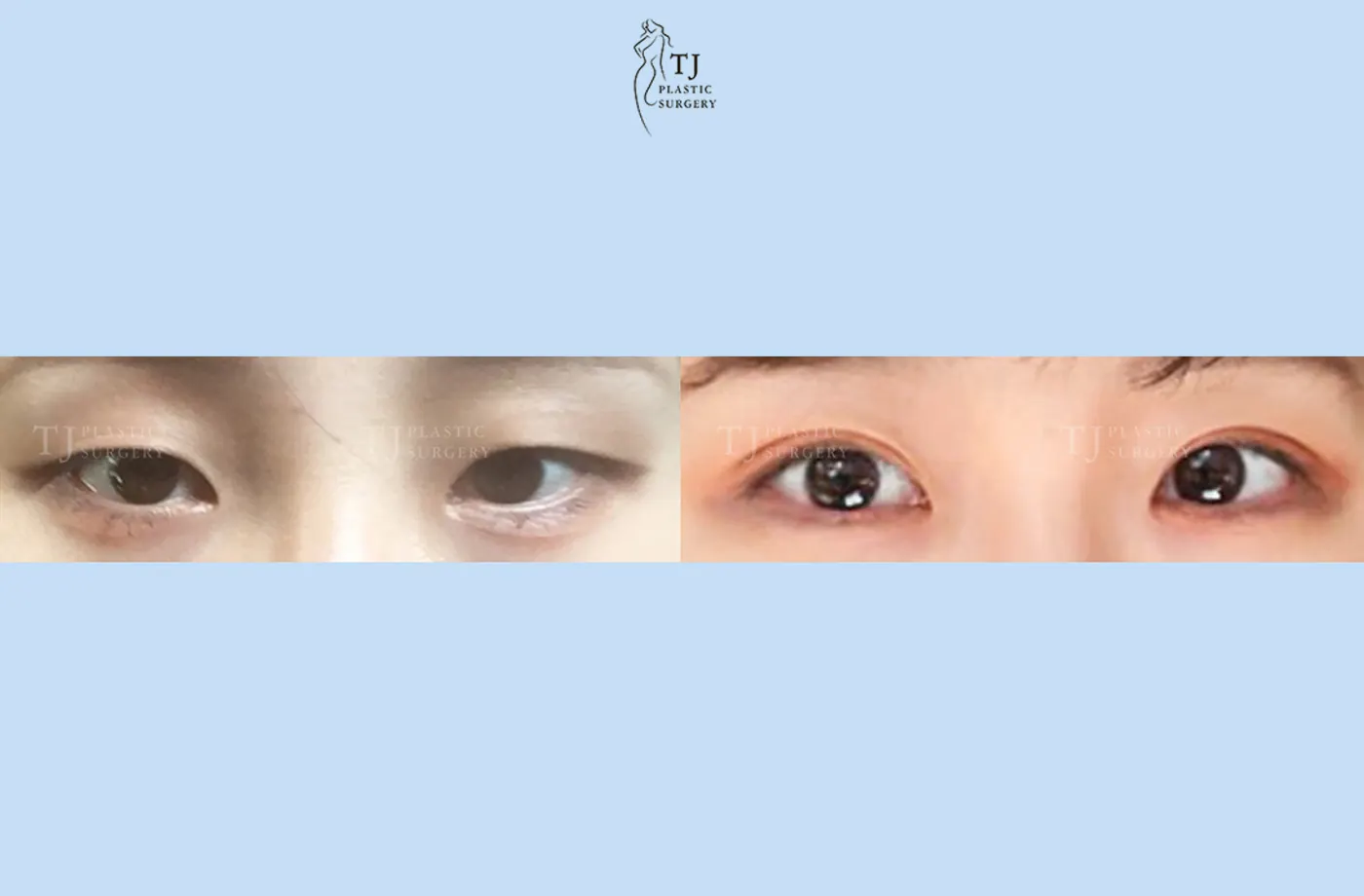 Eyelid surgery at TJ Plastic Surgery Clinic — Front view; before on the left · after on the right