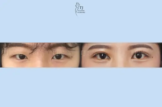 Eyelid surgery — front view before and after at TJ Plastic Surgery Clinic