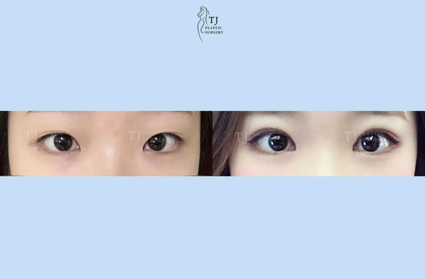 Eyelid surgery at TJ Plastic Surgery Clinic — Front view; before on the left · after on the right