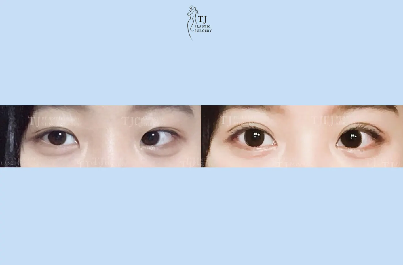 Eyelid surgery at TJ Plastic Surgery Clinic — Front view; before on the left · after on the right