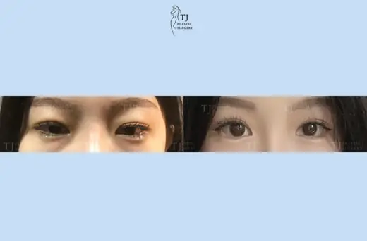 Eyelid surgery — front view before and after at TJ Plastic Surgery Clinic