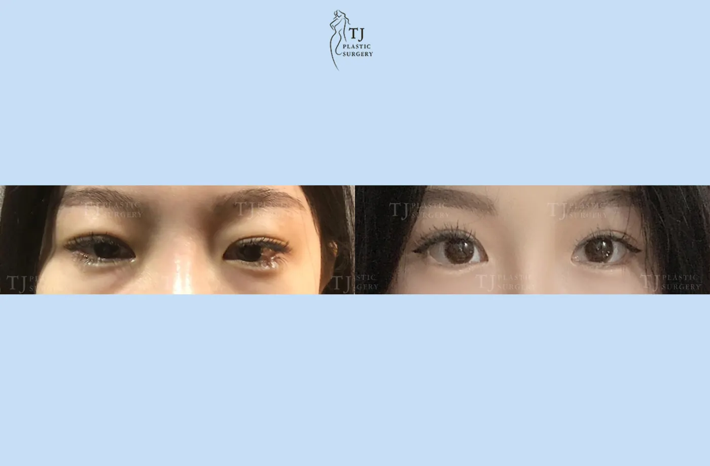 Eyelid surgery at TJ Plastic Surgery Clinic — Front view; before on the left · after on the right