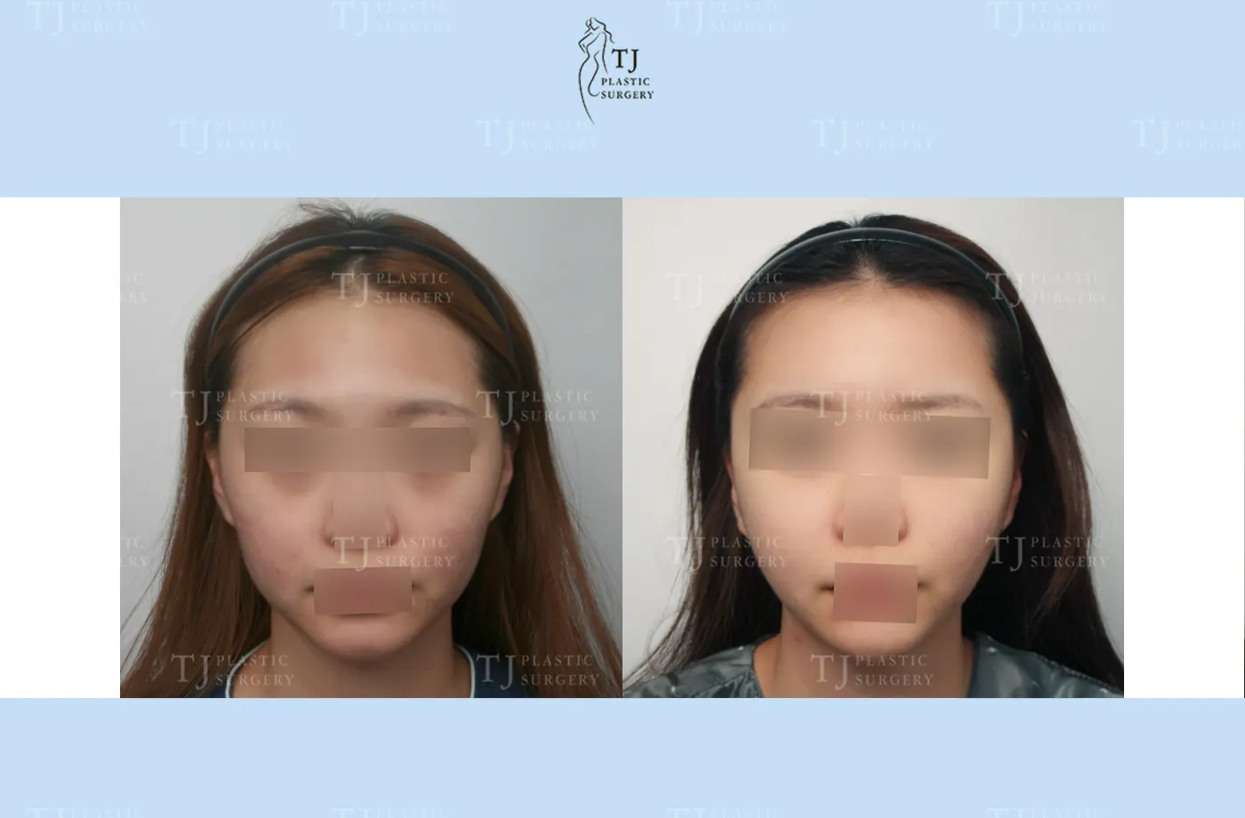 Facial fat grafting at TJ Plastic Surgery Clinic — Front view; before on the left · after on the right