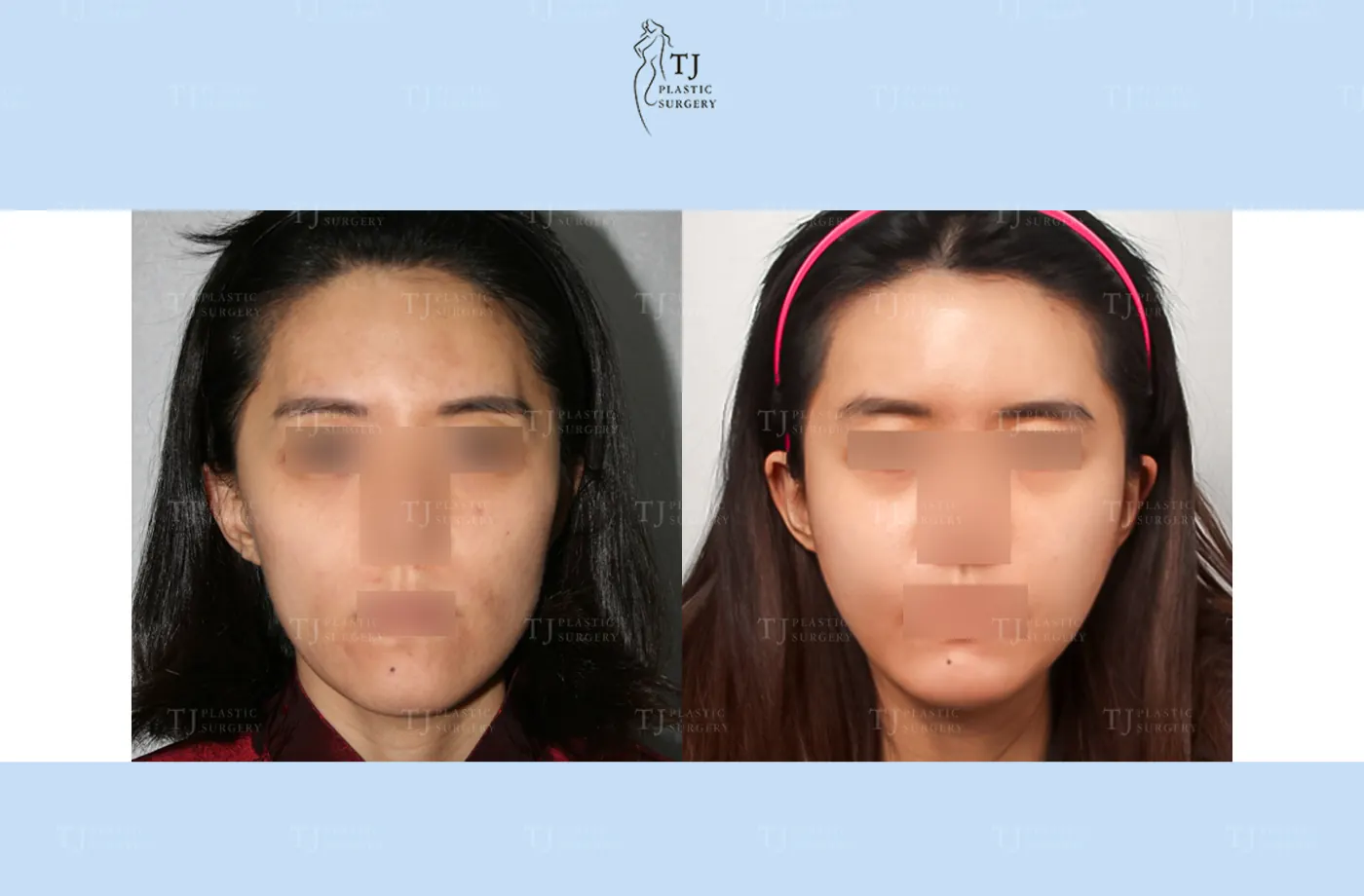 Facial fat grafting at TJ Plastic Surgery Clinic — Front view; before on the left · after 5 months