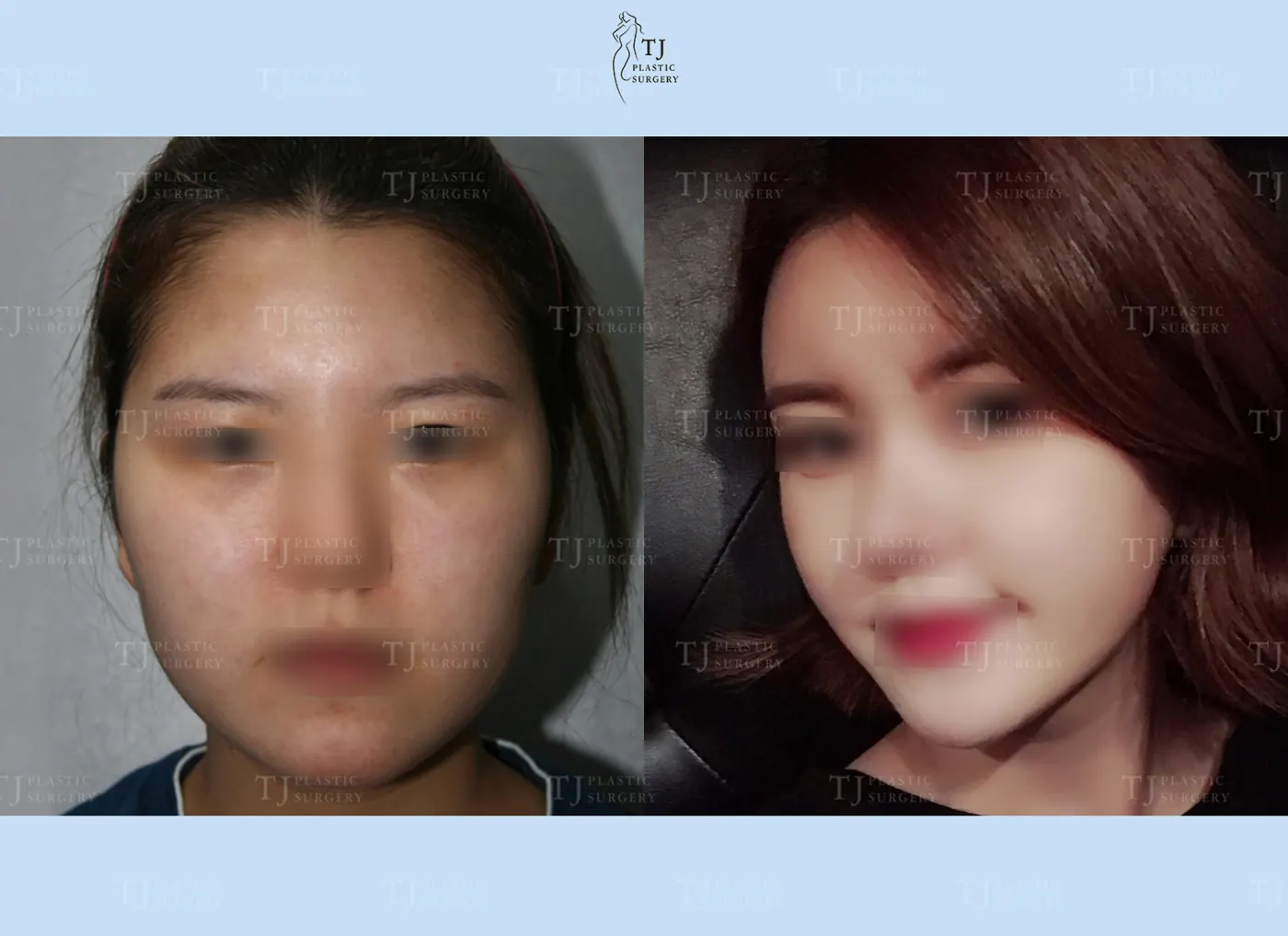 Facial fat grafting at TJ Plastic Surgery Clinic — Front view; before on the left · after on the right