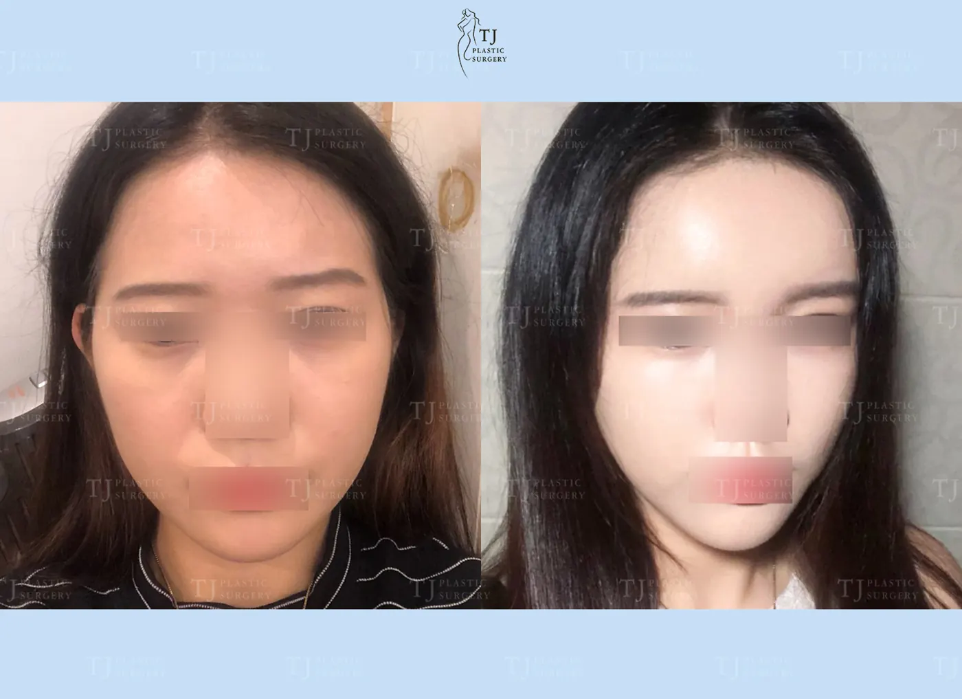 Facial fat grafting at TJ Plastic Surgery Clinic — Front view; before on the left · after on the right