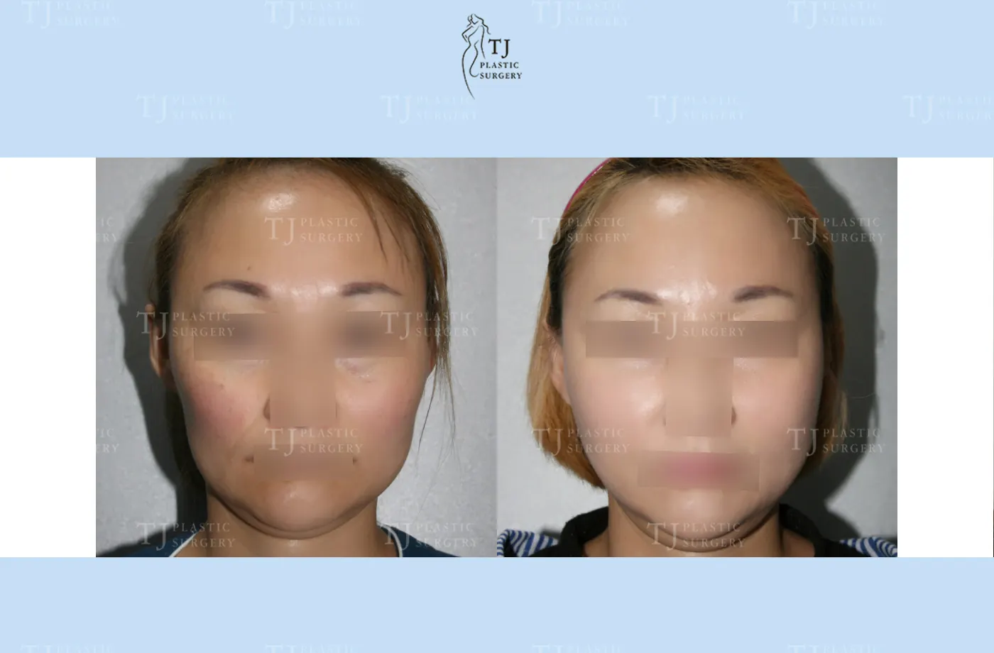 Facial fat grafting at TJ Plastic Surgery Clinic — Front view; before on the left · after on the right