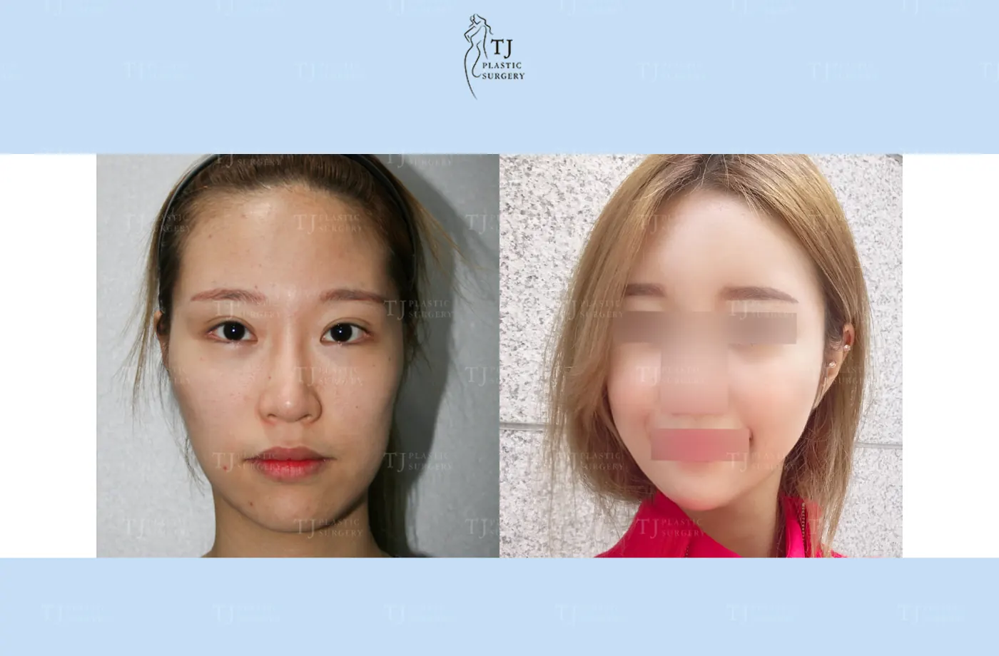 Facial fat grafting at TJ Plastic Surgery Clinic — Front view; before on the left · after 1 month