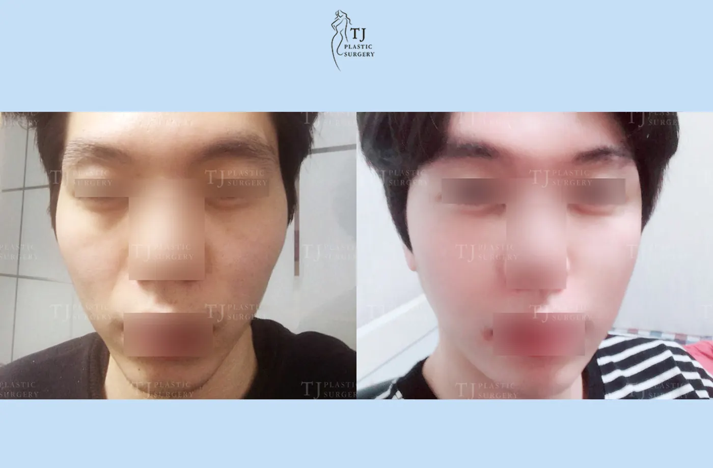 Facial fat grafting at TJ Plastic Surgery Clinic — Front view; before on the left · after on the right
