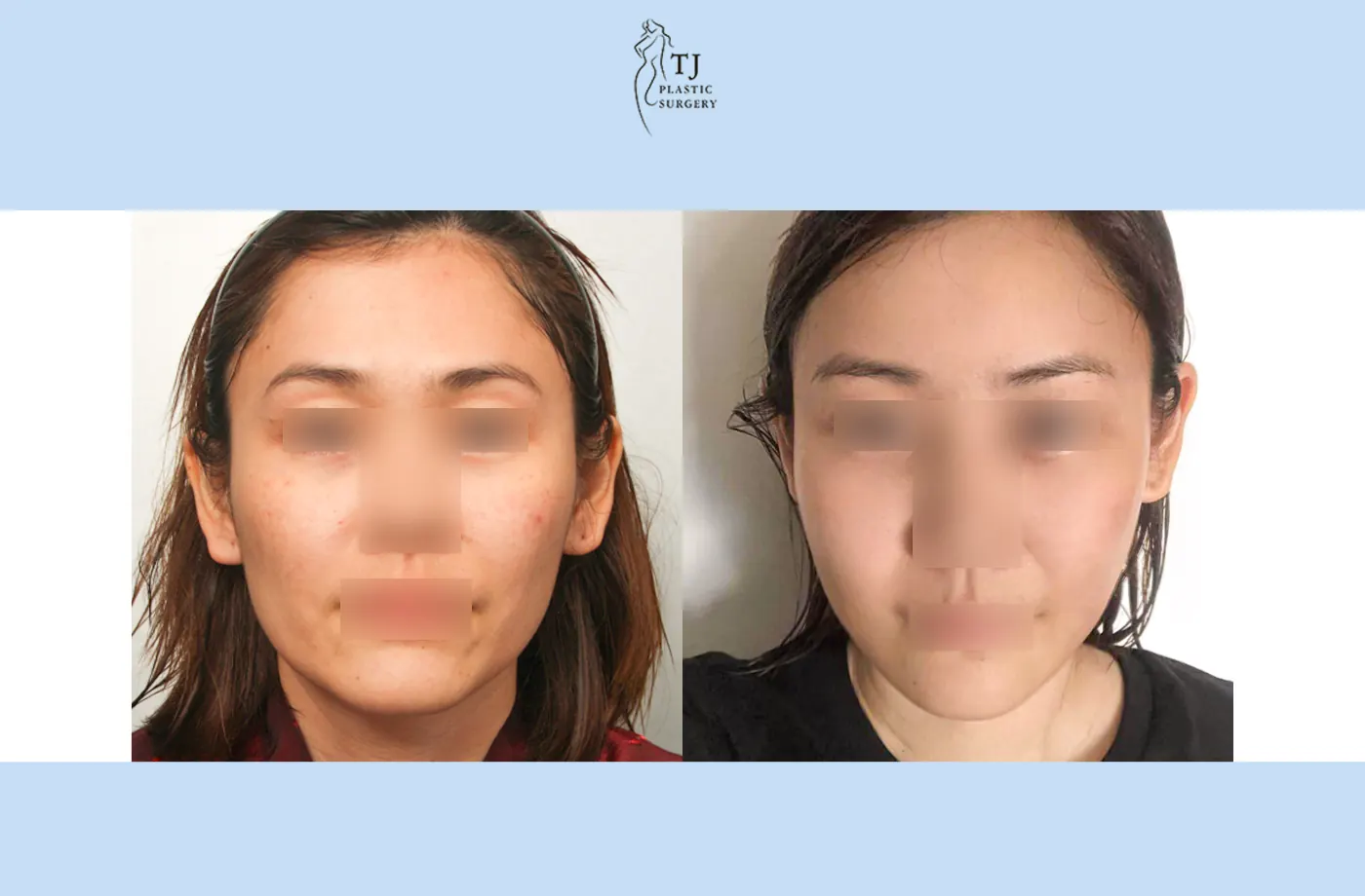 Facial fat grafting at TJ Plastic Surgery Clinic — Front view; before on the left · after 1 month