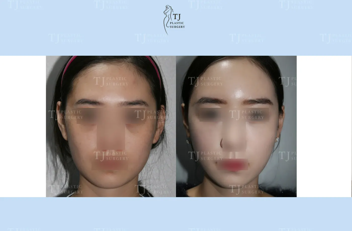 Facial fat grafting at TJ Plastic Surgery Clinic — Front view; before on the left · after on the right