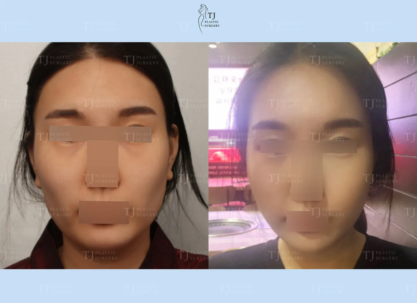 Facial fat grafting at TJ Plastic Surgery Clinic — Front view; before on the left · after on the right