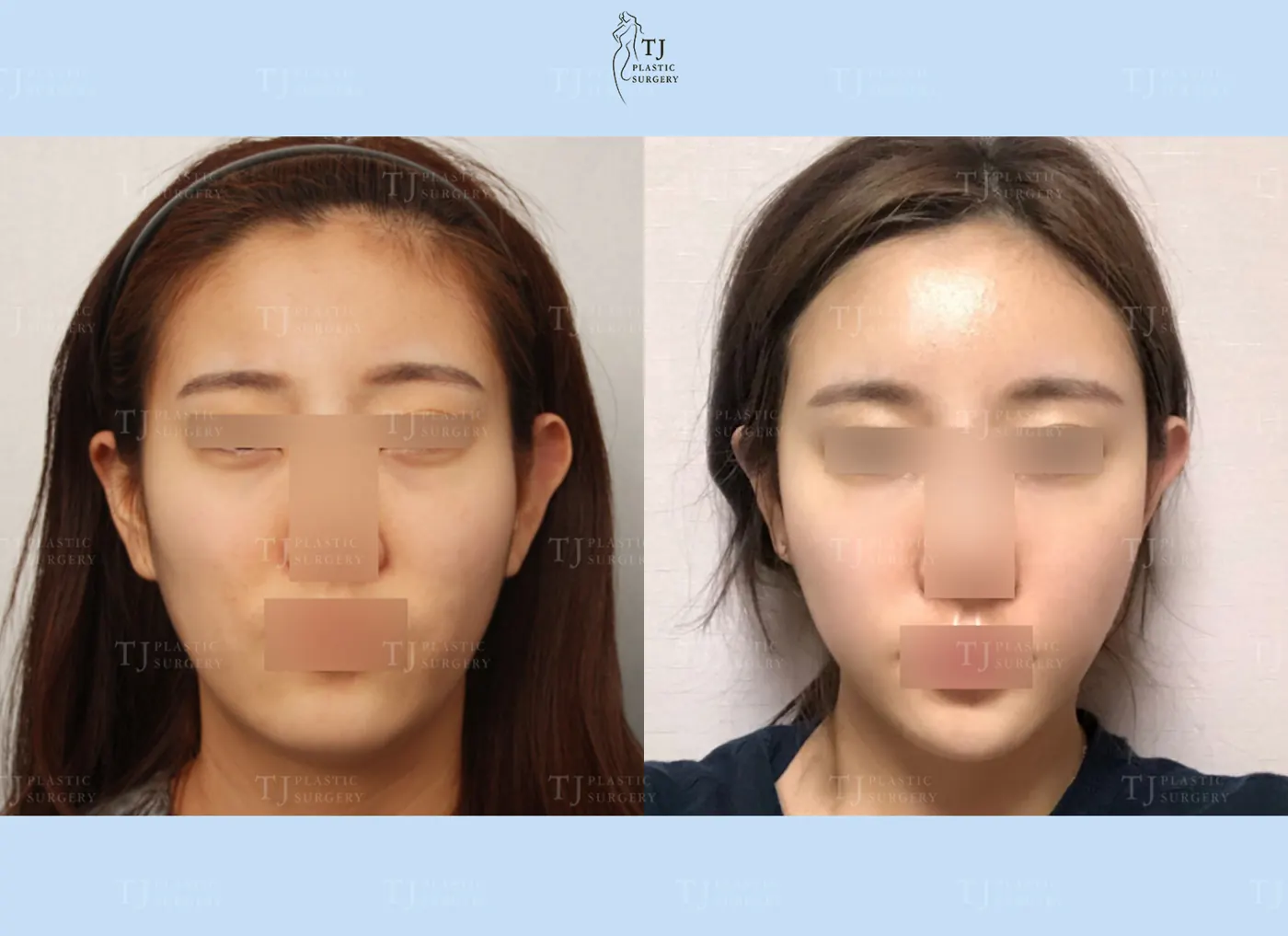 Facial fat grafting at TJ Plastic Surgery Clinic — Front view; before on the left · after on the right
