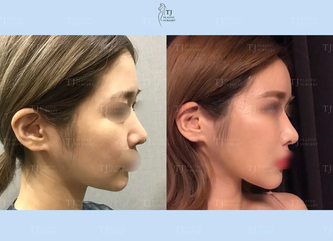 Facial fat grafting at TJ Plastic Surgery Clinic — Side view; before on the left · after on the right