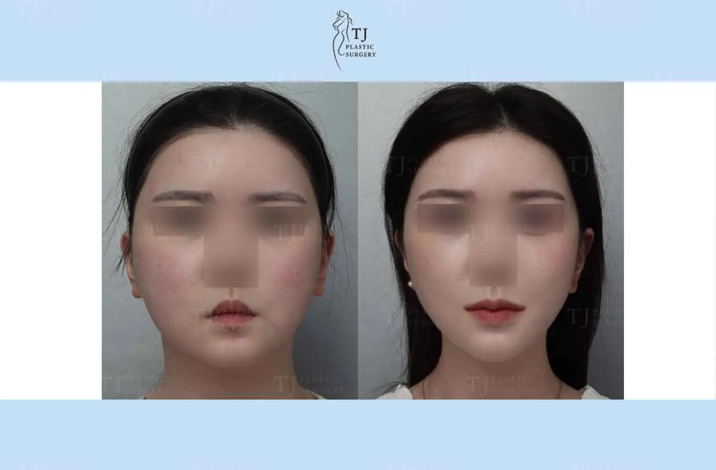 Facial liposuction and thread lifting at TJ Plastic Surgery Clinic — Front view; before on the left · after on the right
