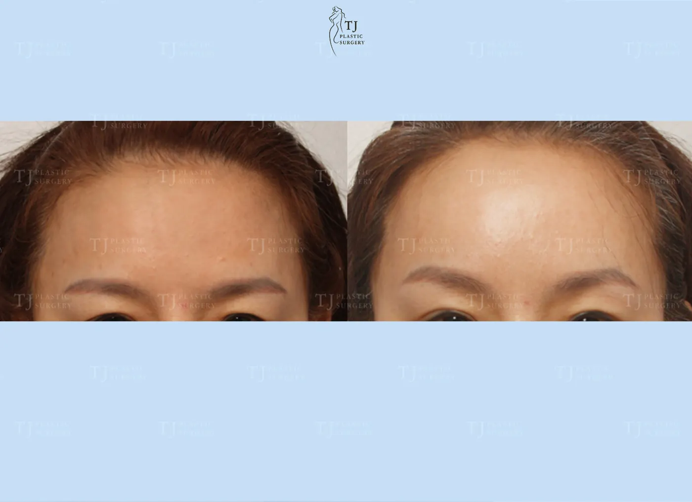 Forehead lift at TJ Plastic Surgery Clinic — Front view; before on the left · after on the right