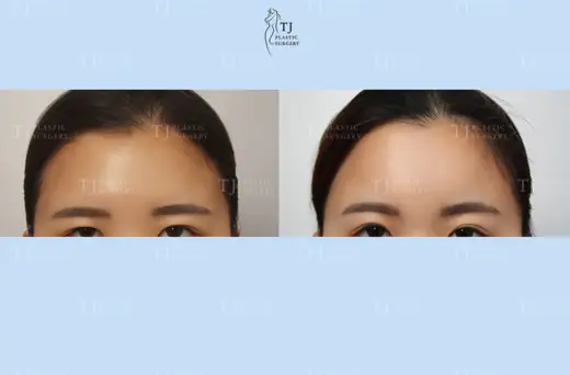 Forehead lift — front view before and after at TJ Plastic Surgery Clinic