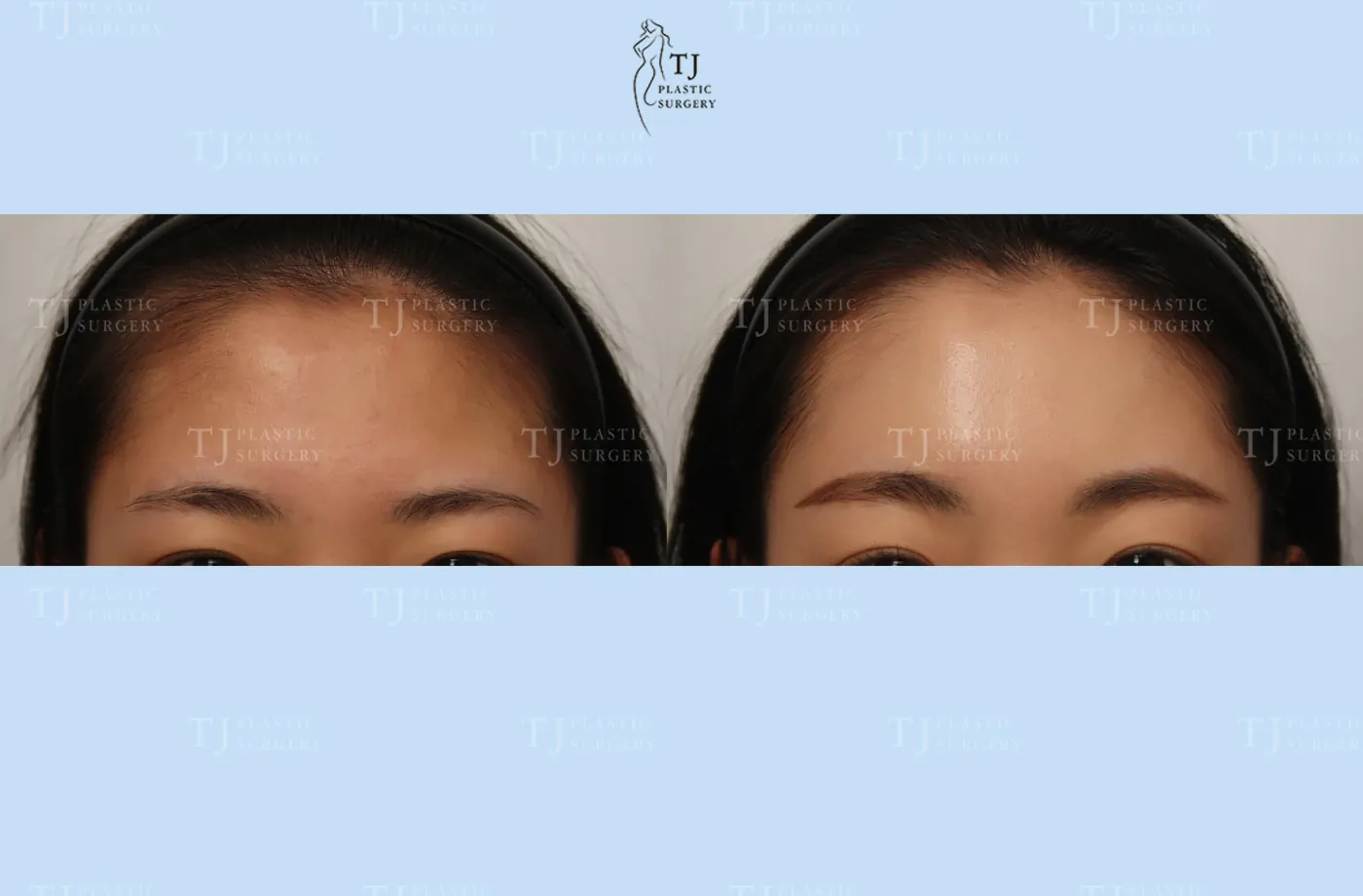 Forehead lift at TJ Plastic Surgery Clinic — Front view; before on the left · after on the right