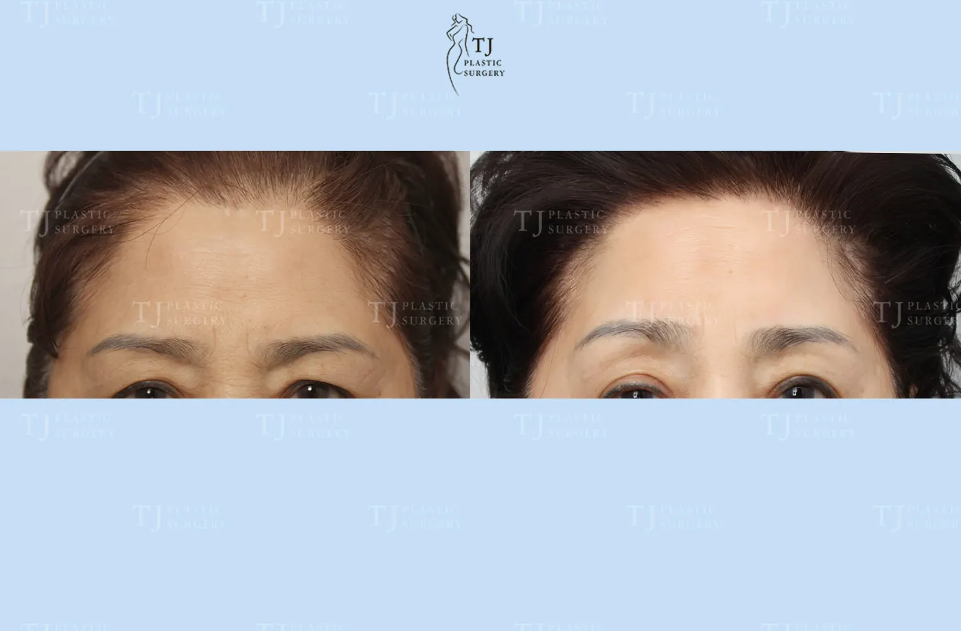 Forehead lift at TJ Plastic Surgery Clinic — Front view; before on the left · after on the right