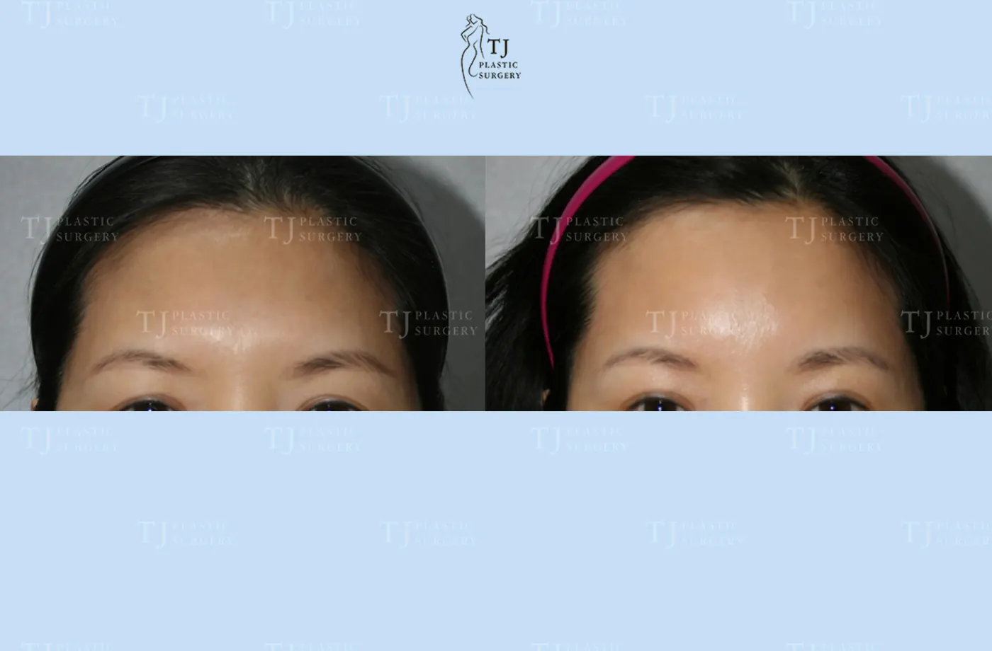 Forehead lift at TJ Plastic Surgery Clinic — Front view; before on the left · after on the right