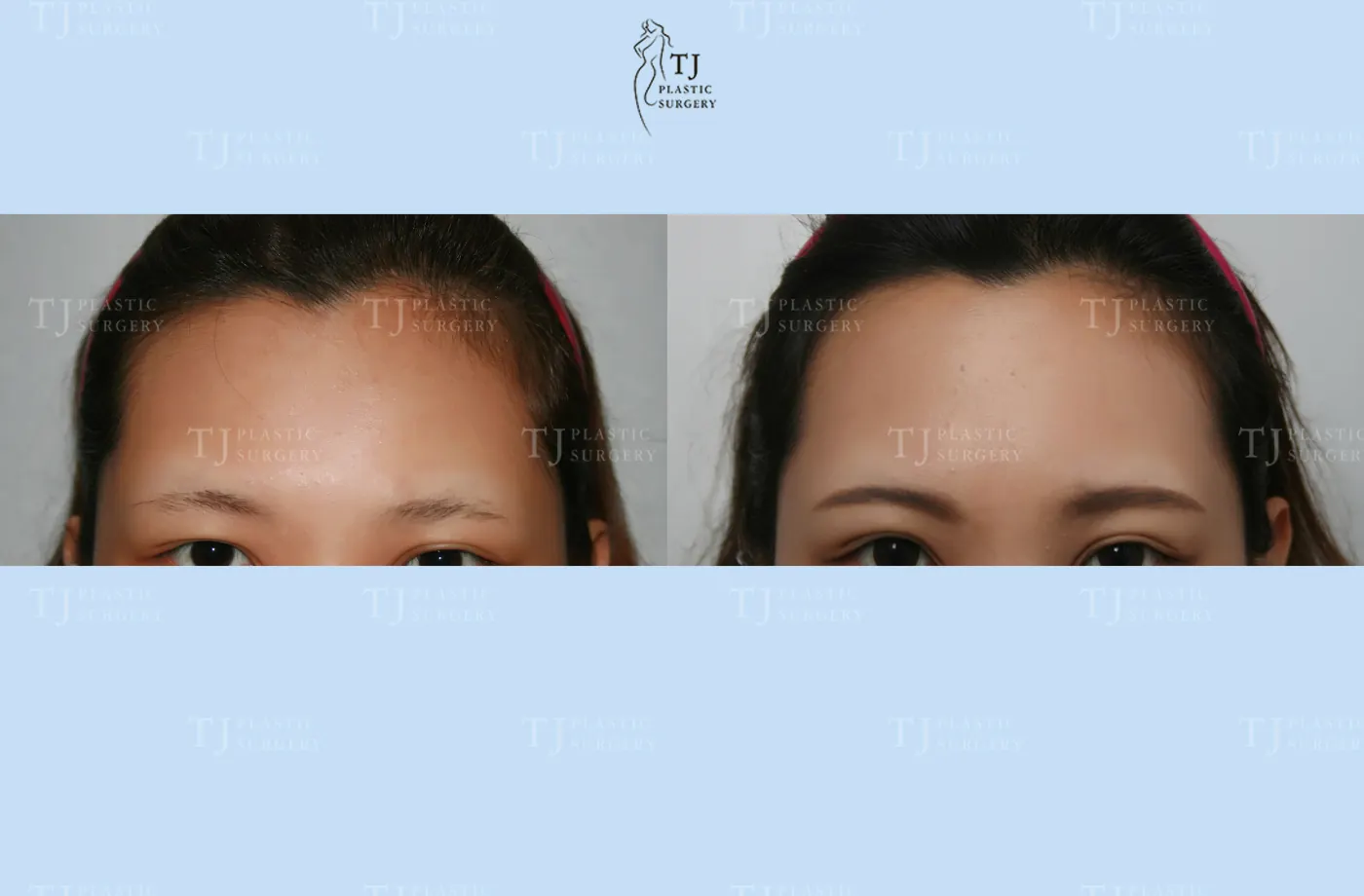 Forehead lift at TJ Plastic Surgery Clinic — Front view; before on the left · after on the right
