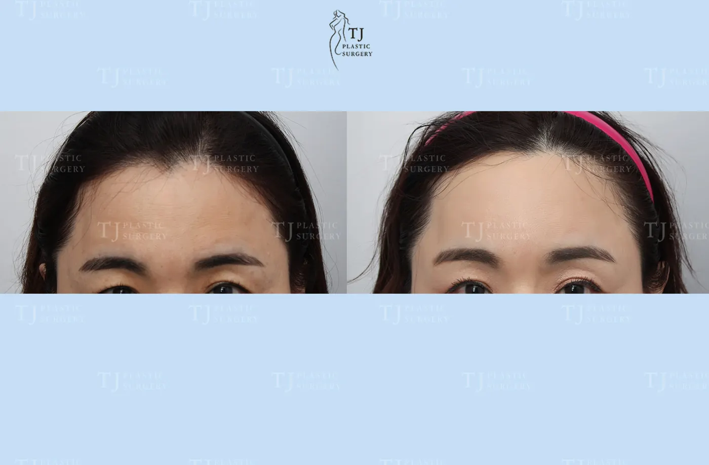 Forehead lift at TJ Plastic Surgery Clinic — Front view; before on the left · after on the right