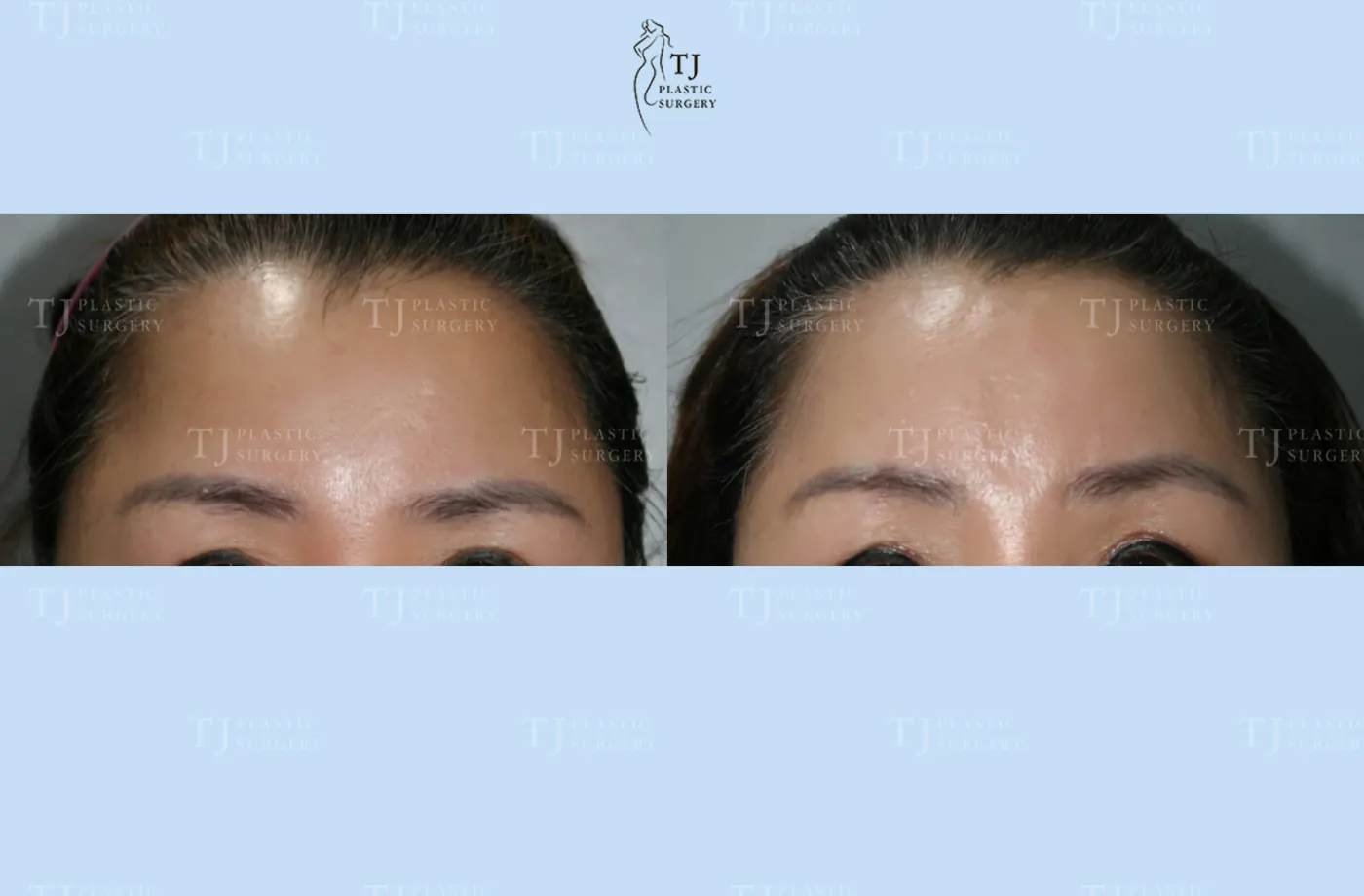 Forehead lift at TJ Plastic Surgery Clinic — Front view; before on the left · after on the right