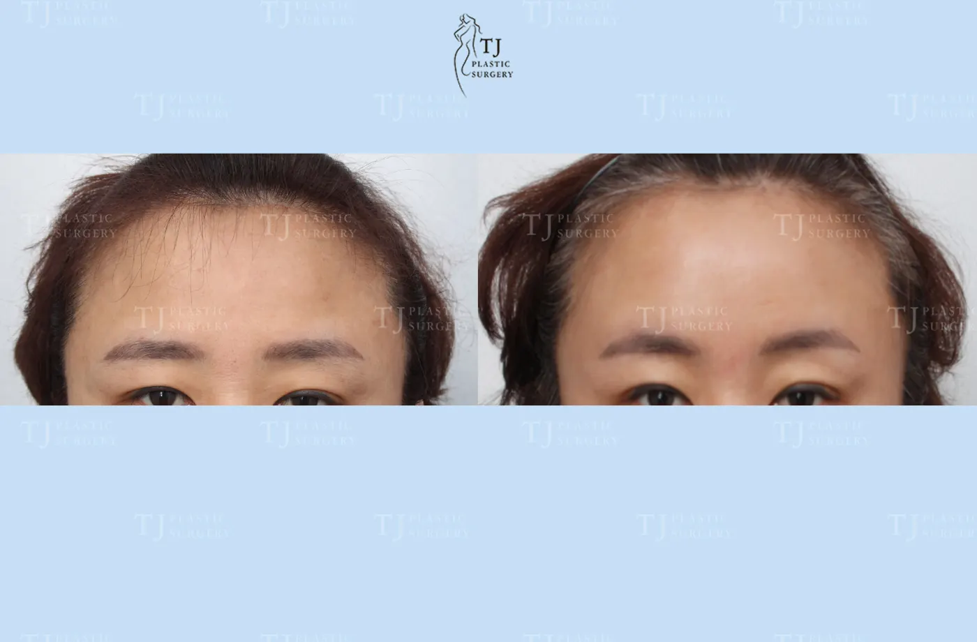 Forehead lift at TJ Plastic Surgery Clinic — Front view; before on the left · after on the right