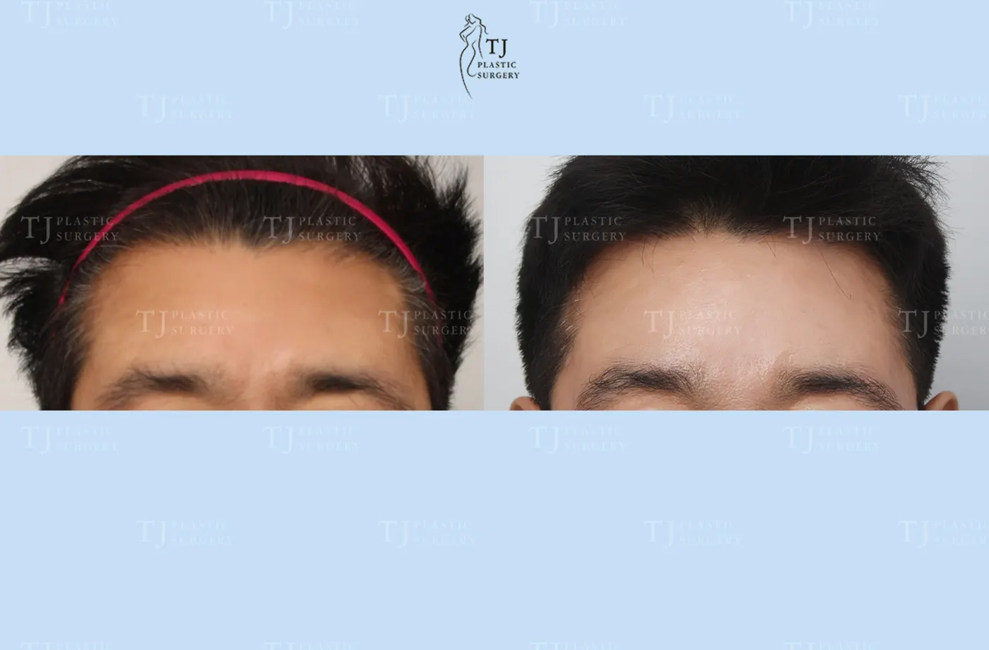 Forehead lift at TJ Plastic Surgery Clinic — Front view; before on the left · after on the right
