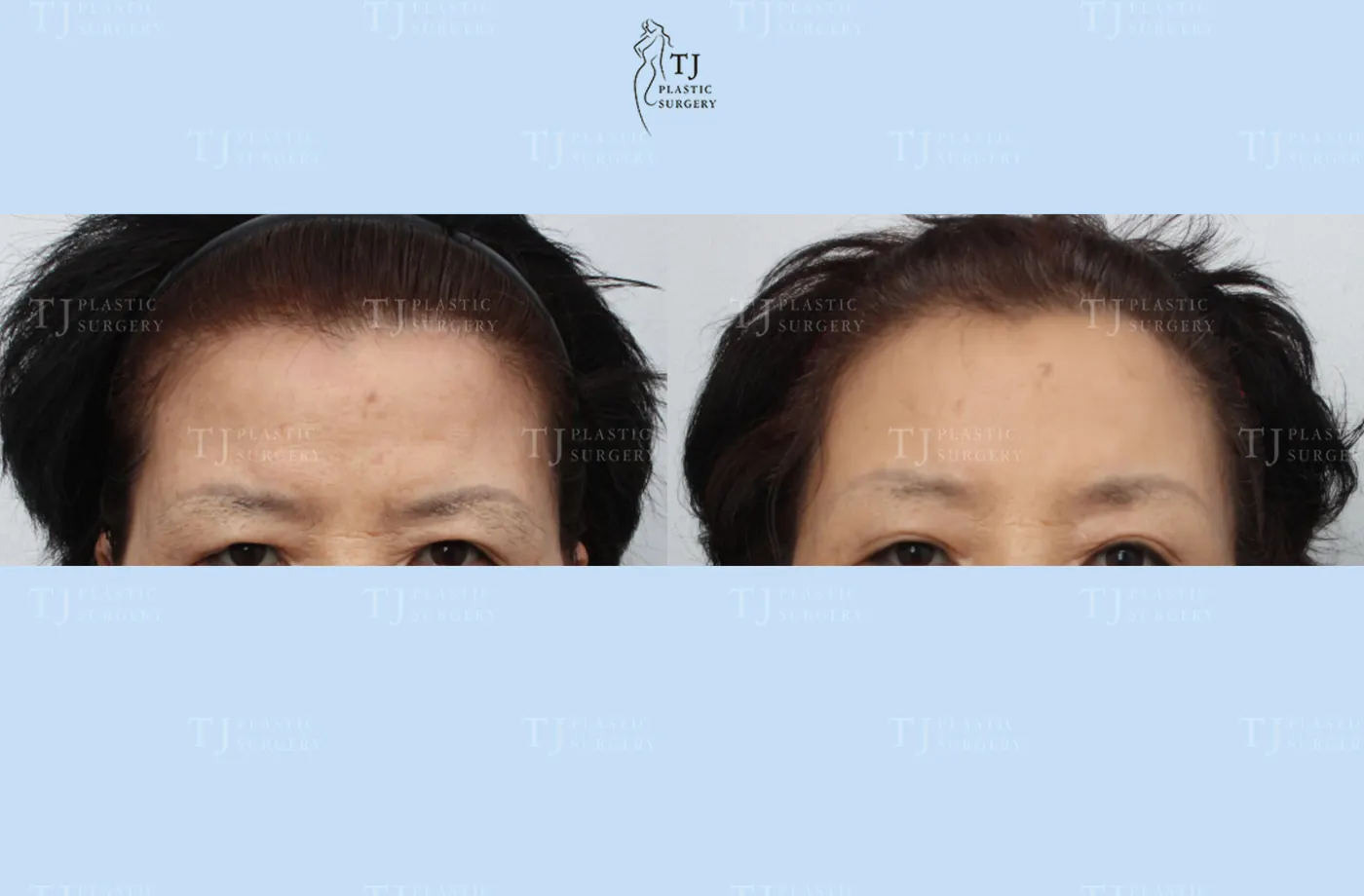 Forehead lift at TJ Plastic Surgery Clinic — Front view; before on the left · after on the right