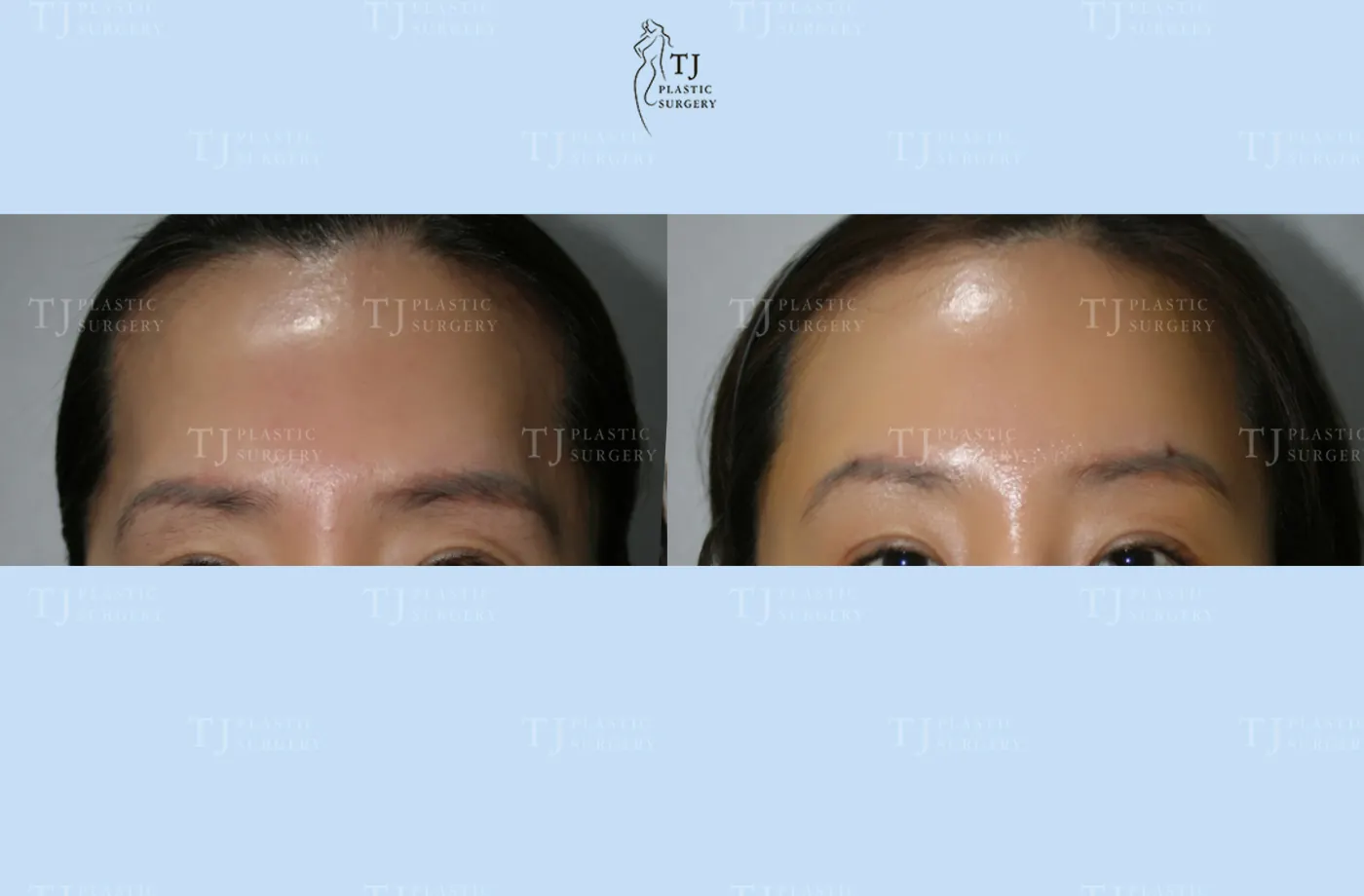 Forehead lift at TJ Plastic Surgery Clinic — Front view; before on the left · after on the right