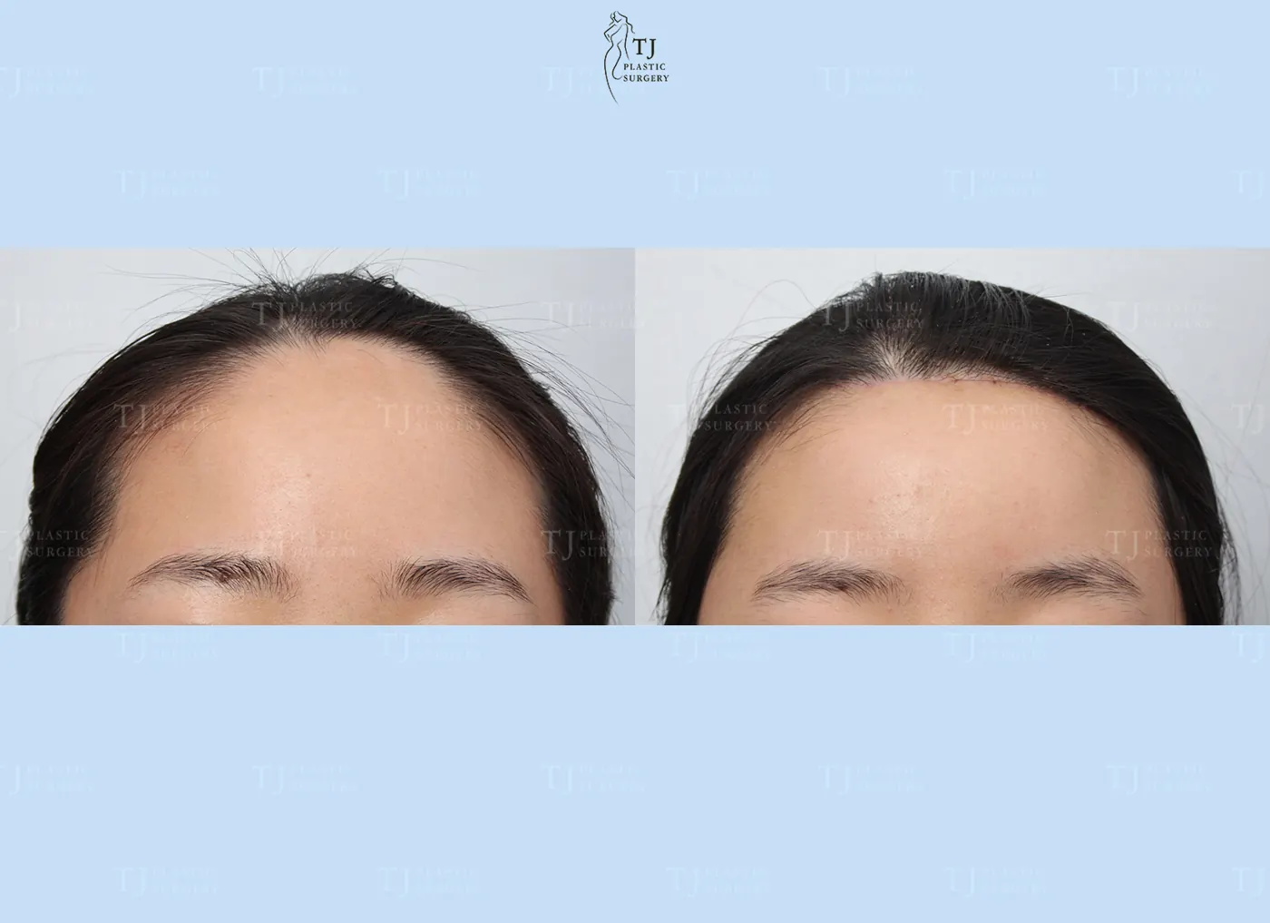 Forehead reduction at TJ Plastic Surgery Clinic — Front view; before on the left · after on the right