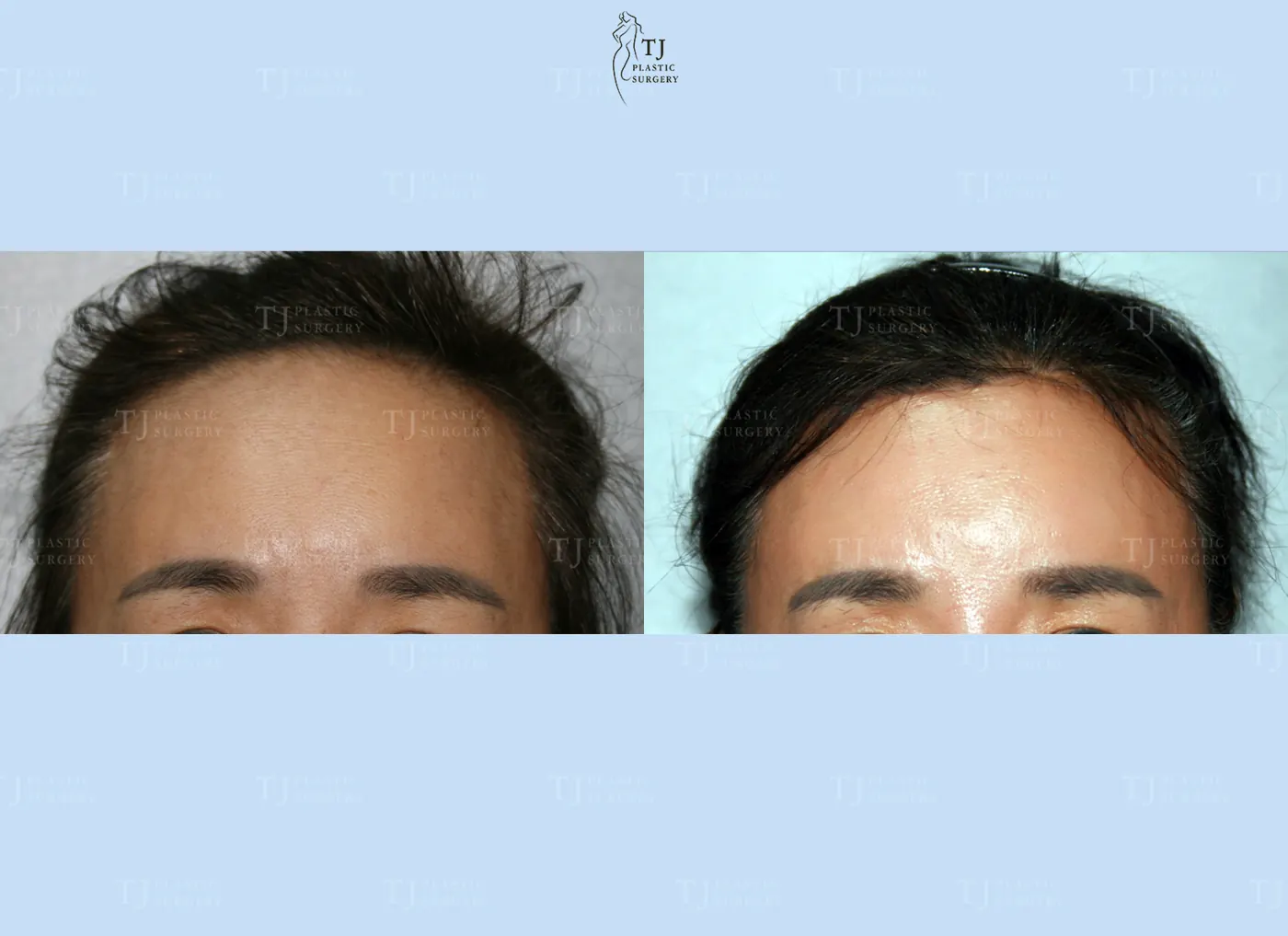 Forehead reduction at TJ Plastic Surgery Clinic — Front view; before on the left · after on the right