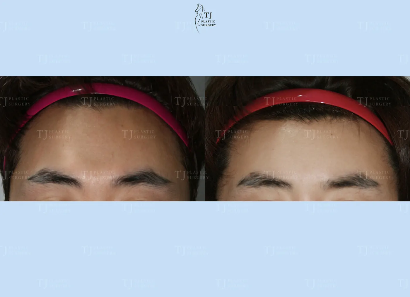 Forehead reduction at TJ Plastic Surgery Clinic — Front view; before on the left · after on the right