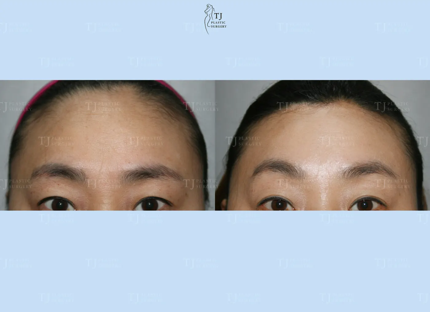 Forehead reduction at TJ Plastic Surgery Clinic — Front view; before on the left · after on the right