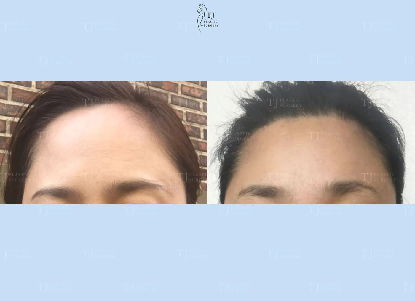 Forehead reduction at TJ Plastic Surgery Clinic — Front view; before on the left · after on the right