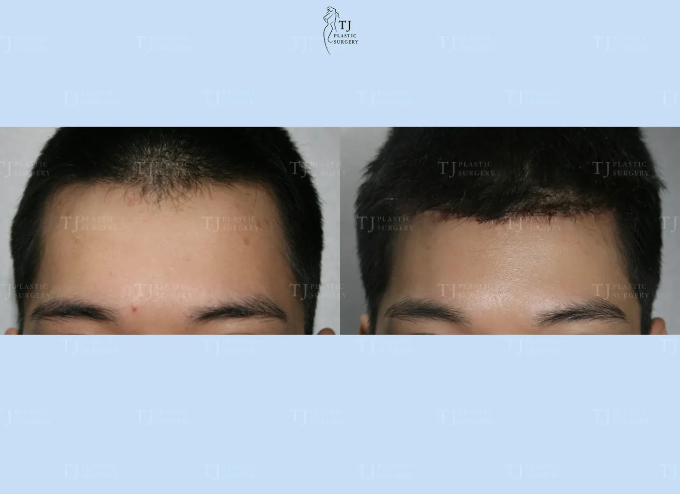 Forehead reduction at TJ Plastic Surgery Clinic — Front view; before on the left · after on the right