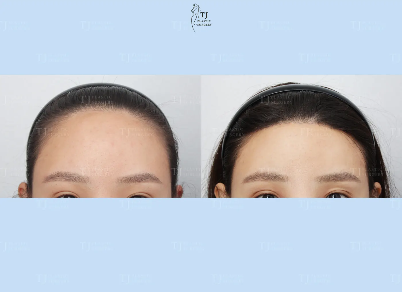 Forehead reduction at TJ Plastic Surgery Clinic — Front view; before on the left · after on the right