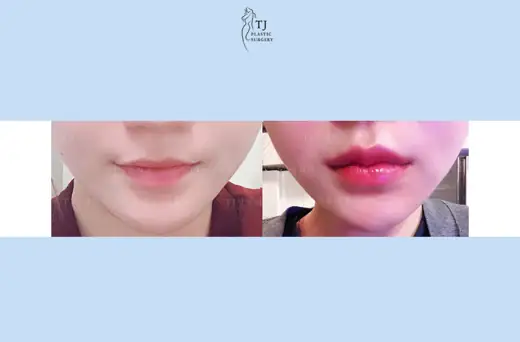 Lip fillers — front view before and after at TJ Plastic Surgery Clinic