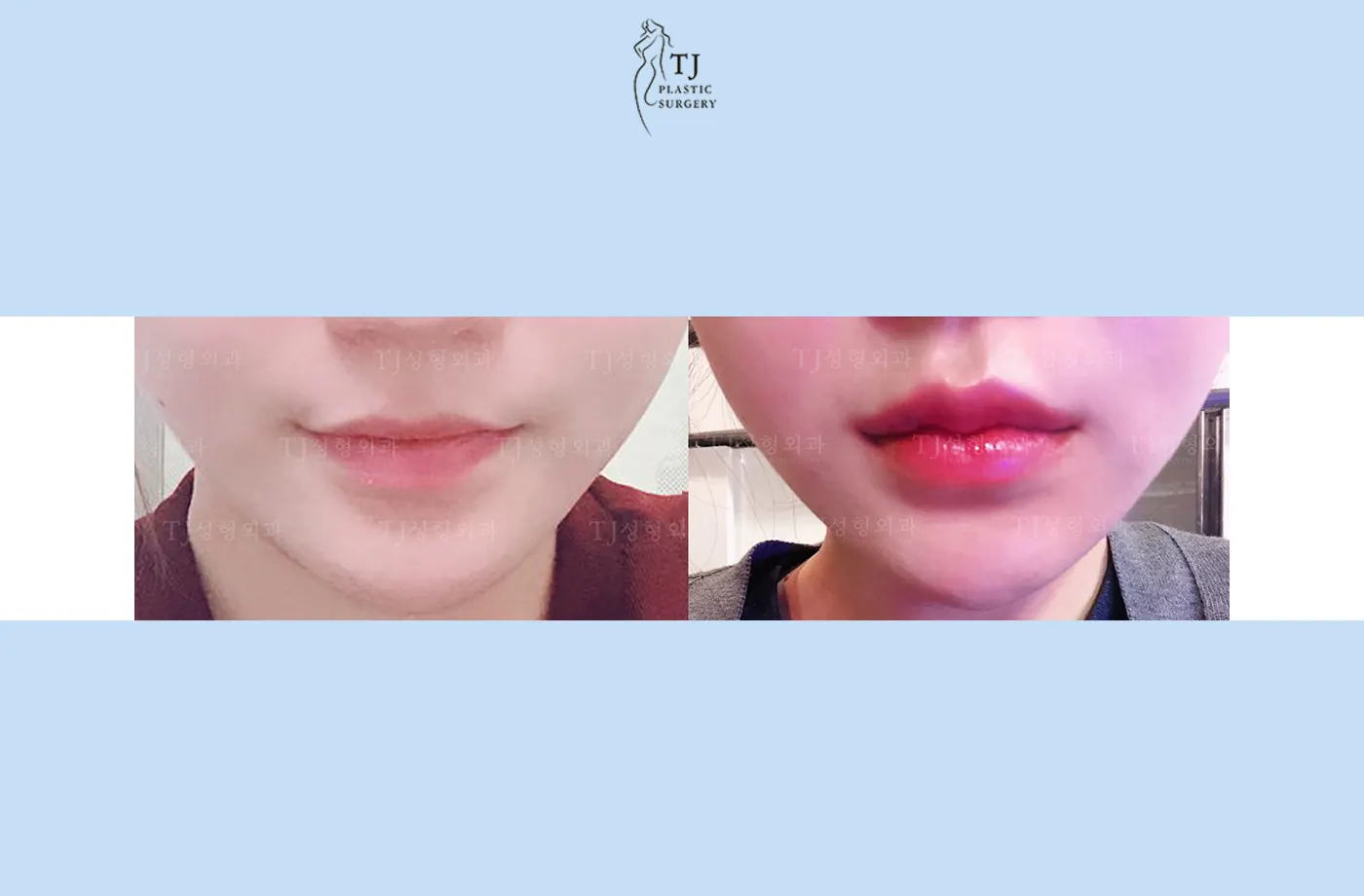 Lip fillers at TJ Plastic Surgery Clinic — Front view; before on the left · after on the right