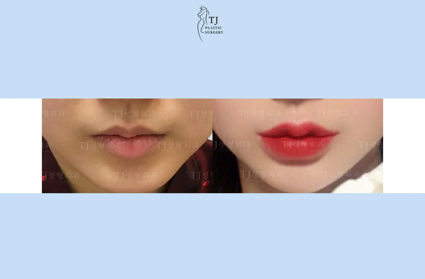 Lip fillers at TJ Plastic Surgery Clinic — Front view; before on the left · after on the right