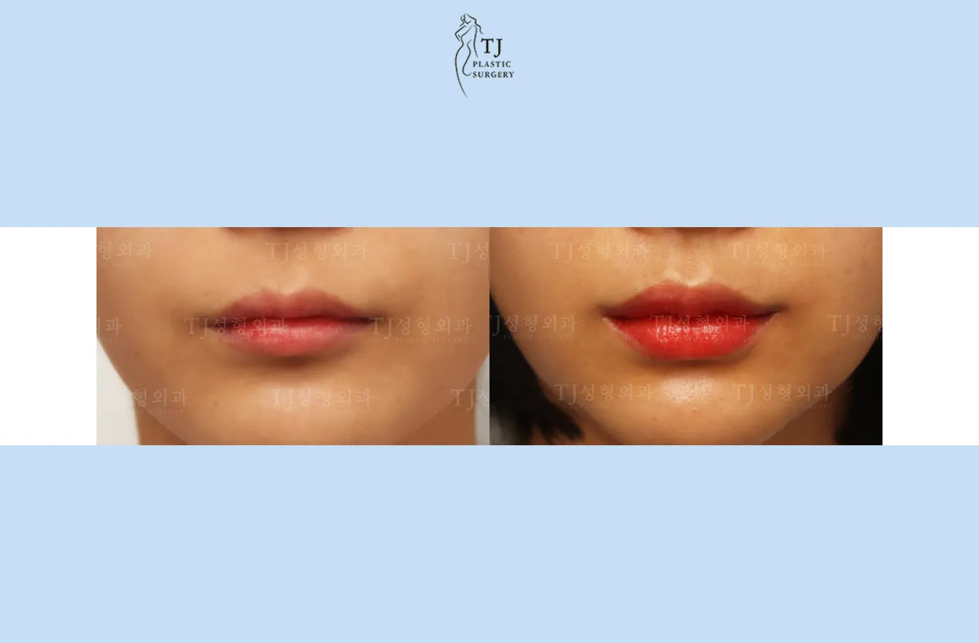 Lip fillers at TJ Plastic Surgery Clinic — Front view; before on the left · after on the right